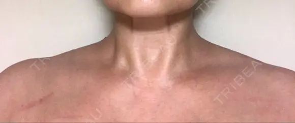 ボトックス（肩） 湘南美容クリニック 奈良院 DAY 9 メイン用