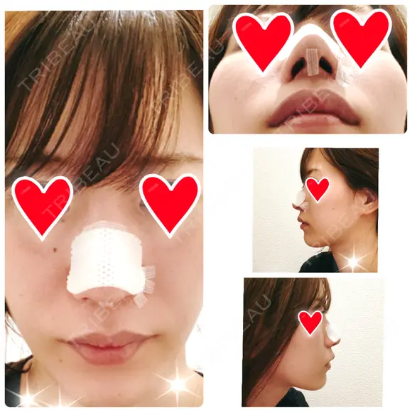 鼻中隔延長（切開） / 軟骨移植 / 鼻修正 / 傷跡修正 神戸大学附属病院 美容外科 DAY 6 メイン用