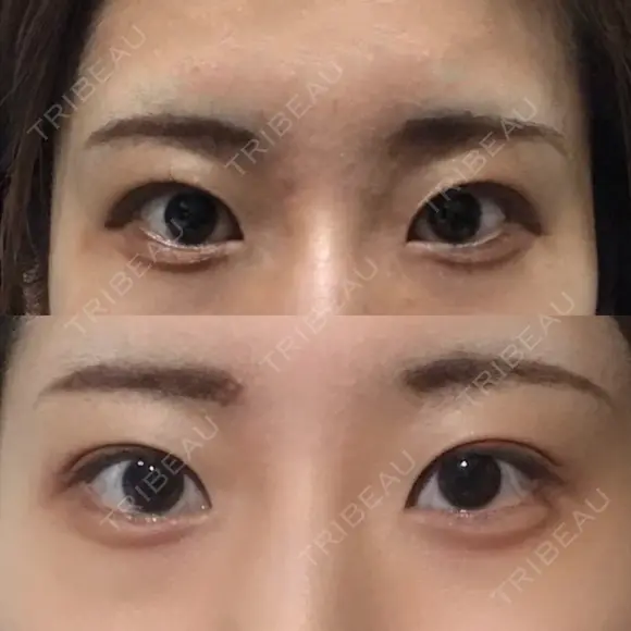目尻切開 / タレ目形成・グラマラスライン（切開） A CLINIC（エークリニック） 銀座院 DAY 42 メイン用