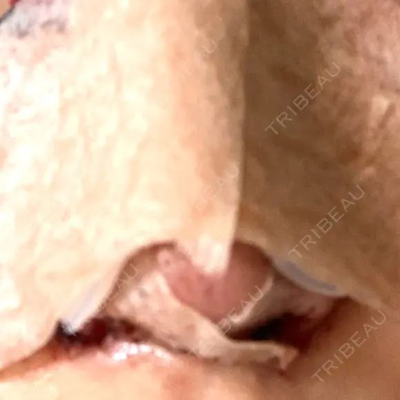 二重切開 / 目頭切開 / 眼瞼下垂（切開） / 鼻中隔延長（切開） / 小鼻縮小（切開） / タレ目形成・グラマラスライン（切開） / 軟骨移植 / 目尻靭帯移動 / 鼻尖縮小 / 口角挙上 / 鼻翼基部形成（貴族手術） 大阪TAクリニック DAY 1 メイン用