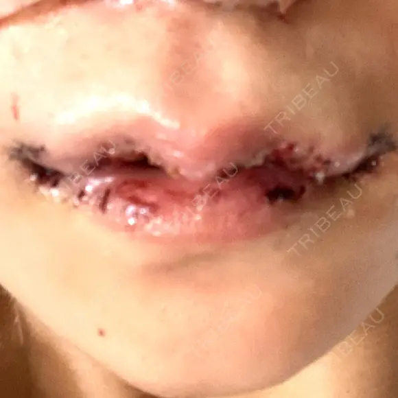 二重切開 / 目頭切開 / 眼瞼下垂（切開） / 鼻中隔延長（切開） / 小鼻縮小（切開） / タレ目形成・グラマラスライン（切開） / 軟骨移植 / 目尻靭帯移動 / 鼻尖縮小 / 口角挙上 / 鼻翼基部形成（貴族手術） 大阪TAクリニック DAY 1 メイン用