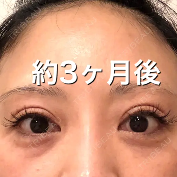 二重切開 BIANCA銀座 DAY 93 メイン用