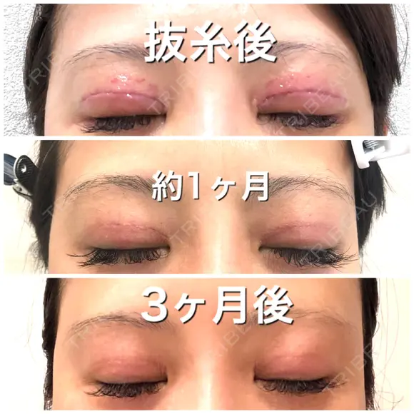 二重切開 BIANCA銀座 DAY 93 メイン用