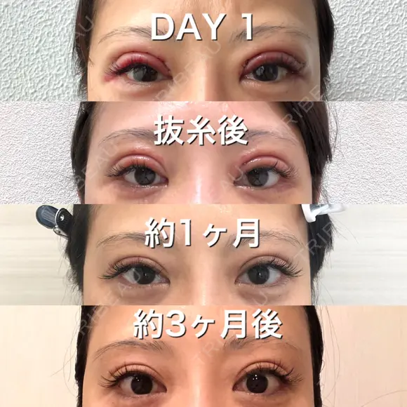 二重切開 BIANCA銀座 DAY 93 メイン用