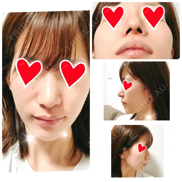 鼻中隔延長（切開） / 軟骨移植 / 鼻修正 / 傷跡修正 神戸大学附属病院 美容外科 DAY 7 メイン用