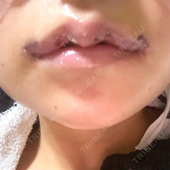 二重切開 / 目頭切開 / 眼瞼下垂（切開） / 鼻中隔延長（切開） / 小鼻縮小（切開） / タレ目形成・グラマラスライン（切開） / 軟骨移植 / 目尻靭帯移動 / 鼻尖縮小 / 口角挙上 / 鼻翼基部形成（貴族手術） 大阪TAクリニック DAY 4 メイン用