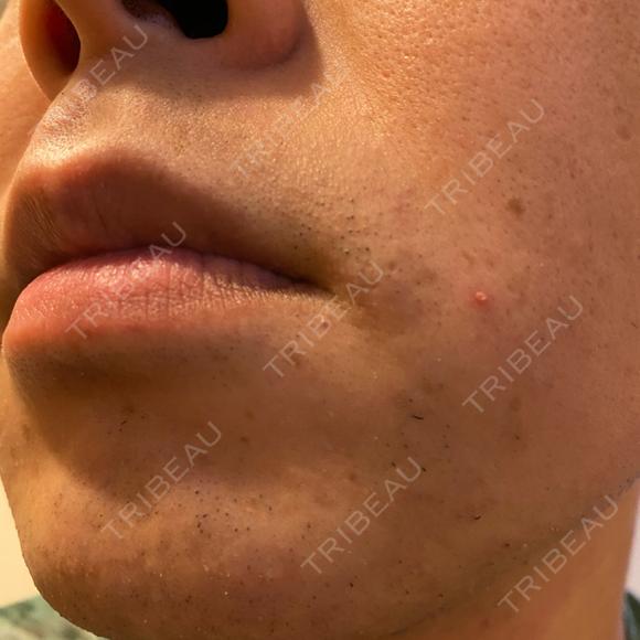 医療脱毛（顔） 自由が丘クリニック DAY 3 メイン用