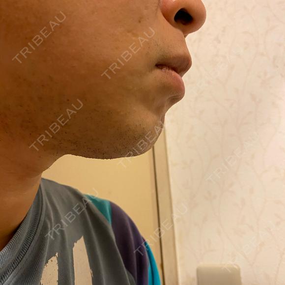 医療脱毛（顔） 自由が丘クリニック DAY 14 メイン用