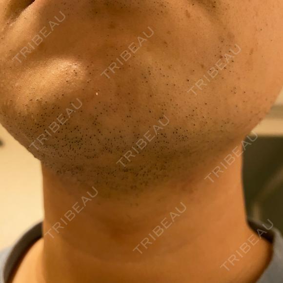 医療脱毛（顔） 自由が丘クリニック DAY 14 メイン用