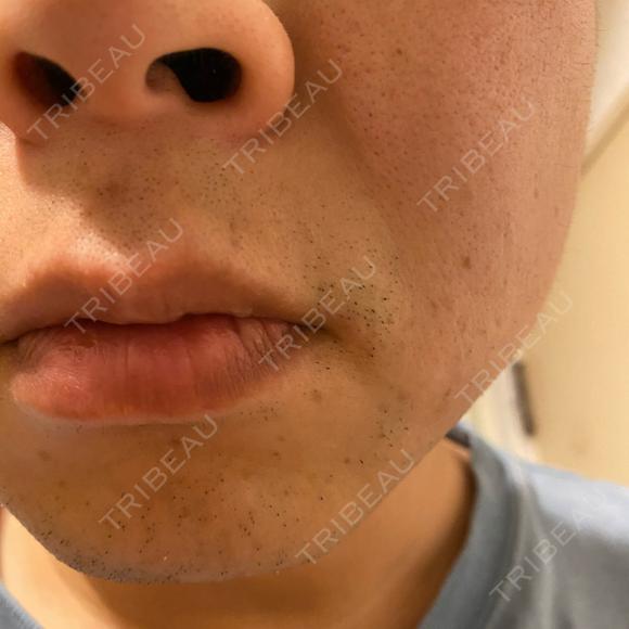 医療脱毛（顔） 自由が丘クリニック AFTER メイン用