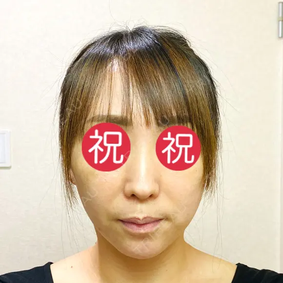 切開リフト 石倉クリニック 水戸院 DAY 31 メイン用