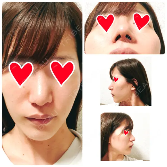 鼻中隔延長（切開） / 軟骨移植 / 鼻修正 / 傷跡修正 神戸大学附属病院 美容外科 DAY 10 メイン用