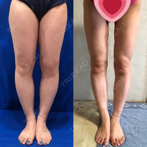 脂肪吸引（脚） / 豊胸（脂肪注入） 水の森美容クリニック 東京新宿院 AFTER メイン用