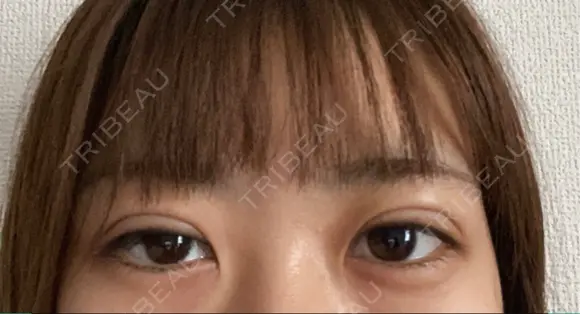 二重埋没 ながしまクリニック DAY 1 メイン用