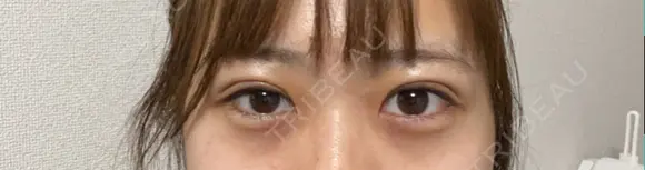 二重埋没 ながしまクリニック DAY 2 メイン用
