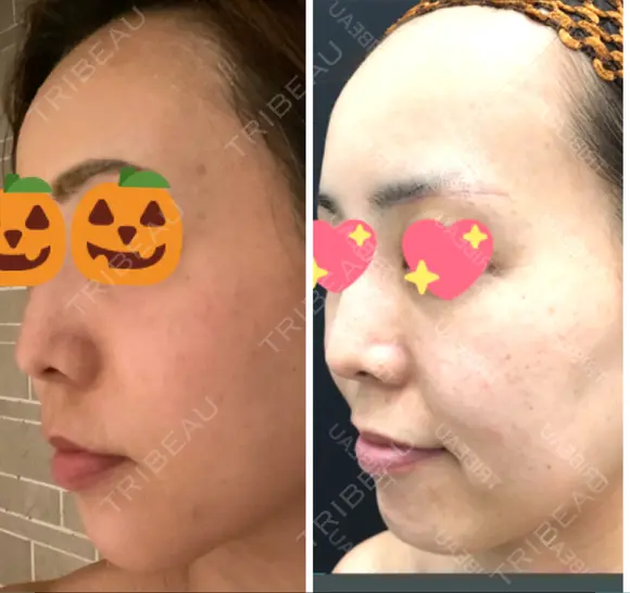 糸リフト / ボトックス（あご） / 肌ヒアルロン酸注入（たるみ・シワ改善） / ボトックス（口角） 湘南美容クリニック 秋葉原院 DAY 134 メイン用