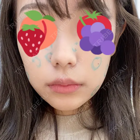 脂肪溶解注射（顔） / 美容点滴・美容注射（美肌） / ボトックス（肩） / ハイフ（顔） リエンジャン整形外科 江南店 AFTER メイン用