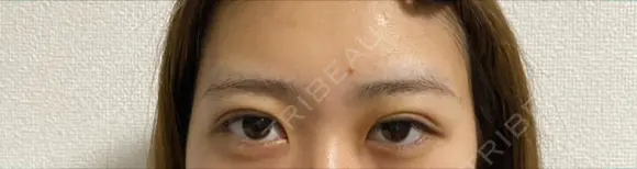 二重埋没 ながしまクリニック DAY 4 メイン用
