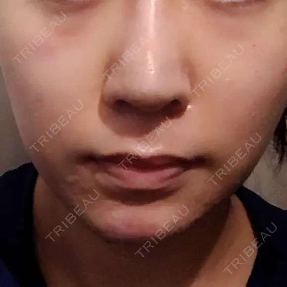 隆鼻術 / 鼻尖形成（切開） / 軟骨移植 / 鼻修正 湘南美容クリニック 柏院 DAY 309 メイン用