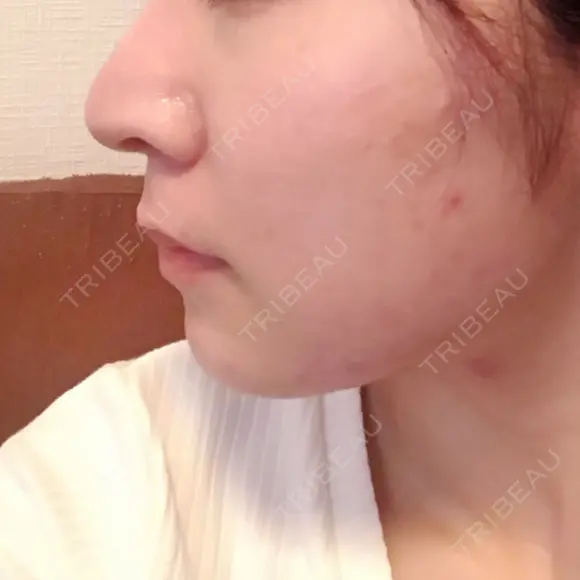 隆鼻術 / 鼻尖形成（切開） / 軟骨移植 / 鼻修正 湘南美容クリニック 柏院 DAY 317 メイン用