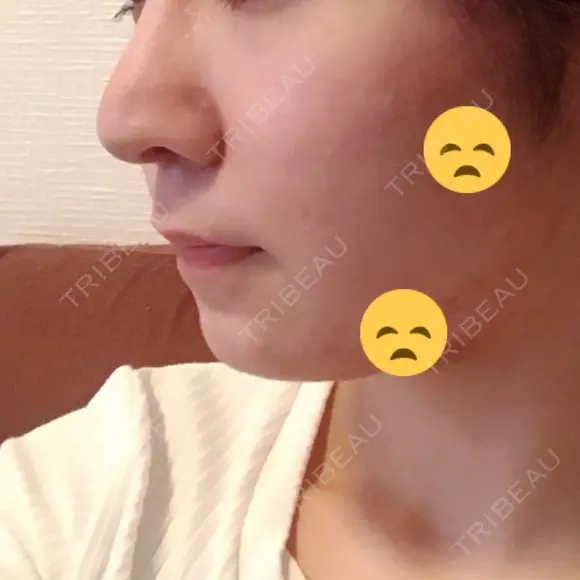 隆鼻術 / 鼻尖形成（切開） / 軟骨移植 / 鼻修正 湘南美容クリニック 柏院 DAY 317 メイン用