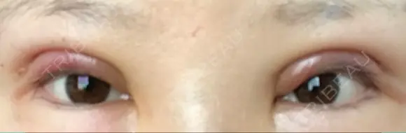 二重切開 / 眼瞼下垂（切開） / 上まぶたたるみ取り / 上まぶたの脂肪取り 湘南美容クリニック 船橋院 DAY 1 メイン用