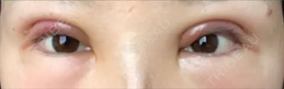 二重切開 / 眼瞼下垂（切開） / 上まぶたたるみ取り / 上まぶたの脂肪取り 湘南美容クリニック 船橋院 DAY 2 メイン用