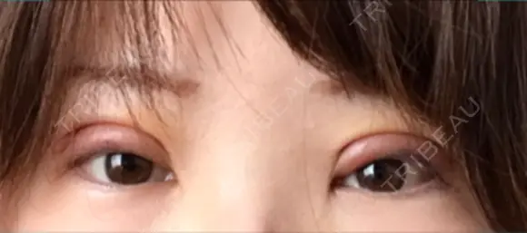 二重切開 / 眼瞼下垂（切開） / 上まぶたたるみ取り / 上まぶたの脂肪取り 湘南美容クリニック 船橋院 DAY 5 メイン用