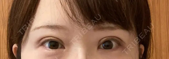 二重切開 / 眼瞼下垂（切開） / 上まぶたたるみ取り / 上まぶたの脂肪取り 湘南美容クリニック 船橋院 DAY 20 メイン用