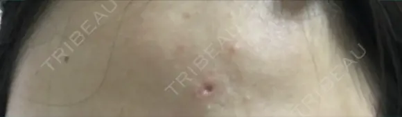 ほくろ・いぼ切除（肌） / ほくろ・いぼ除去レーザー（肌） 赤坂メディカルMクリニック DAY 1 メイン用