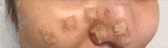 ほくろ・いぼ切除（肌） / ほくろ・いぼ除去レーザー（肌） 赤坂メディカルMクリニック DAY 2 メイン用