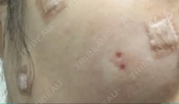 ほくろ・いぼ切除（肌） / ほくろ・いぼ除去レーザー（肌） 赤坂メディカルMクリニック DAY 13 メイン用