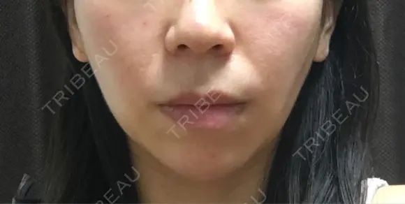 バッカルファット除去 / 脂肪吸引（顔） 湘南美容クリニック 那覇院 DAY 152 メイン用