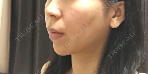 バッカルファット除去 / 脂肪吸引（顔） 湘南美容クリニック 那覇院 DAY 152 メイン用
