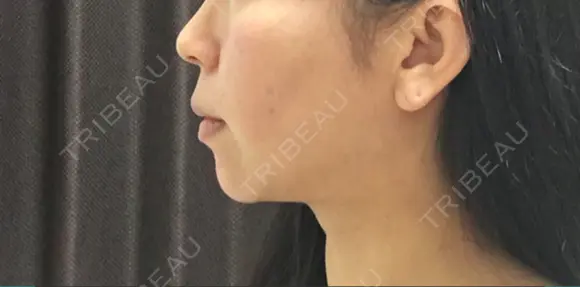 バッカルファット除去 / 脂肪吸引（顔） 湘南美容クリニック 那覇院 DAY 152 メイン用