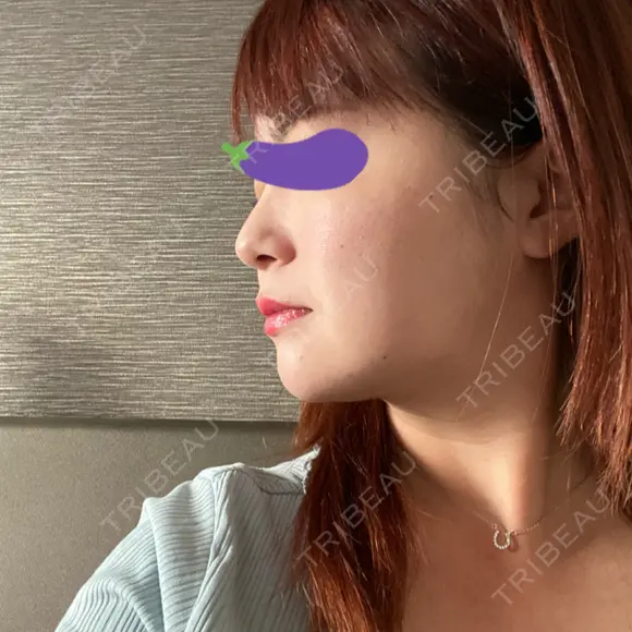 脂肪吸引（顔） 表参道スキンクリニック 表参道院 DAY 88 メイン用