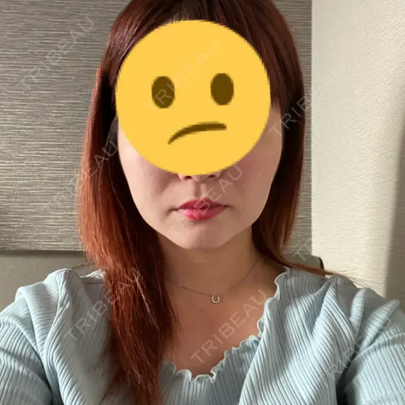 脂肪吸引（顔） 表参道スキンクリニック 表参道院 DAY 88 メイン用