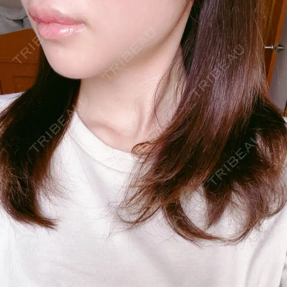 口唇縮小術 くさのたろうクリニック DAY 42 メイン用