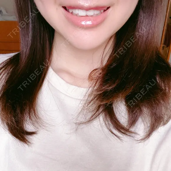 口唇縮小術 くさのたろうクリニック DAY 42 メイン用
