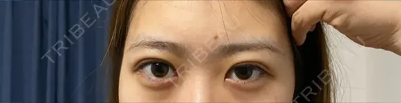 二重埋没 ながしまクリニック DAY 5 メイン用