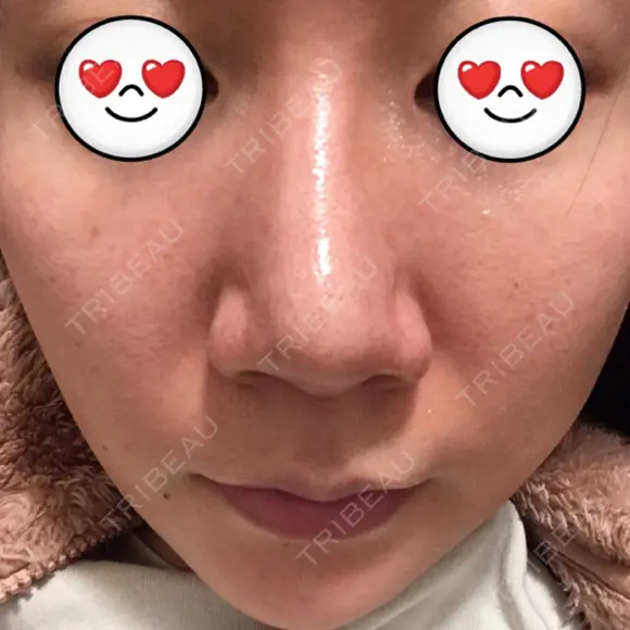 鼻尖形成（切開） / ヒアルロン酸注入（鼻） 東京ヒルズクリニック 新宿院 DAY 76 メイン用