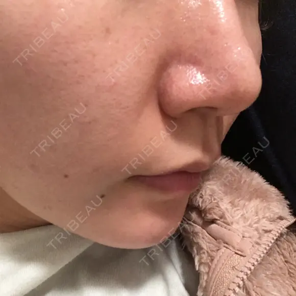 鼻尖形成（切開） / ヒアルロン酸注入（鼻） 東京ヒルズクリニック 新宿院 DAY 76 メイン用