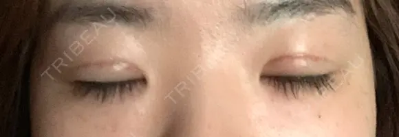 二重切開 / 眼瞼下垂（切開） / 上まぶたの脂肪取り ひまりクリニック DAY 31 メイン用