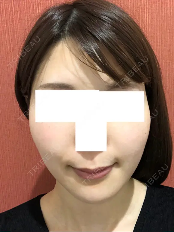糸リフト / バッカルファット除去 / 脂肪吸引（顔） / ボトックス（エラ・小顔） 湘南美容クリニック 秋葉原院 AFTER メイン用