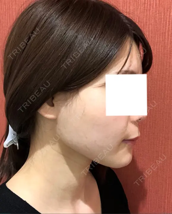 糸リフト / バッカルファット除去 / 脂肪吸引（顔） / ボトックス（エラ・小顔） 湘南美容クリニック 秋葉原院 DAY 105 メイン用
