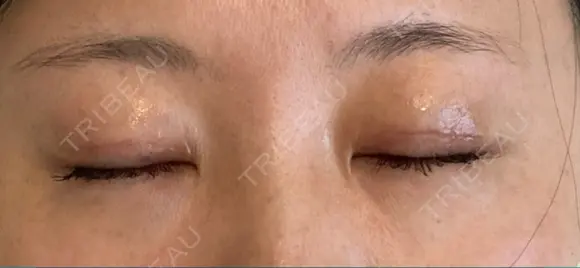 眼瞼下垂（切開） くさのたろうクリニック DAY 11 メイン用