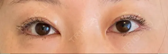 眼瞼下垂（切開） くさのたろうクリニック DAY 11 メイン用