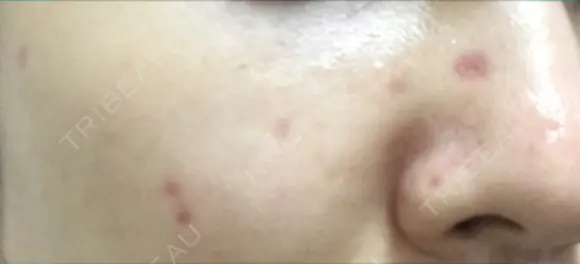 ほくろ・いぼ切除（肌） / ほくろ・いぼ除去レーザー（肌） 赤坂メディカルMクリニック DAY 22 メイン用