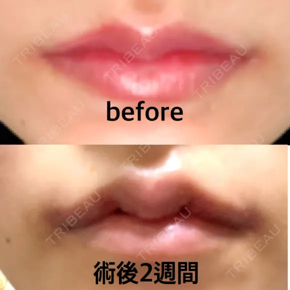 二重切開 / 目頭切開 / 眼瞼下垂（切開） / 鼻中隔延長（切開） / 小鼻縮小（切開） / タレ目形成・グラマラスライン（切開） / 軟骨移植 / 目尻靭帯移動 / 鼻尖縮小 / 口角挙上 / 鼻翼基部形成（貴族手術） 大阪TAクリニック AFTER メイン用