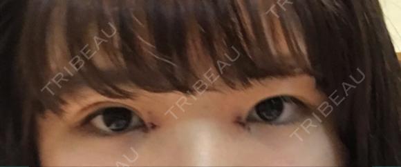 二重埋没 / 目頭切開 湘南美容クリニック 京都院 DAY 5 メイン用